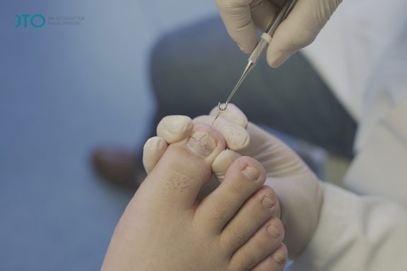 Un podólogo realiza un tratamiento en un dedo del pie.